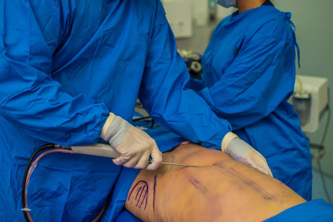 Liposuction